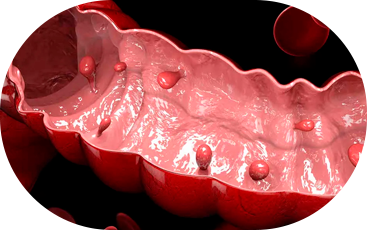 Pólipos Intestinais